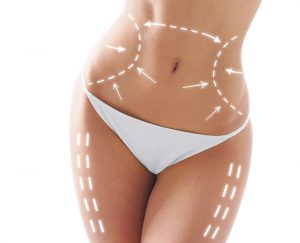 Liposcultura